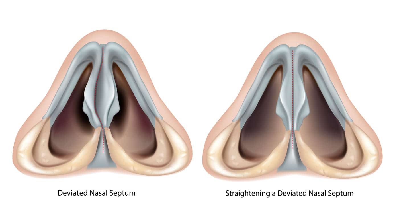 Deviated nasal septum and Straightening a Deviated Nasal Septum