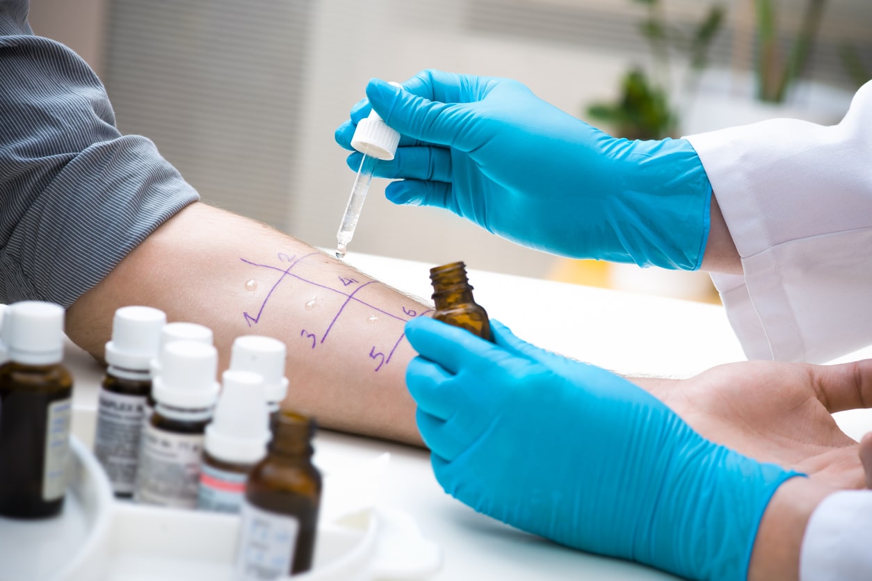 Skin prick allergy test stock photo